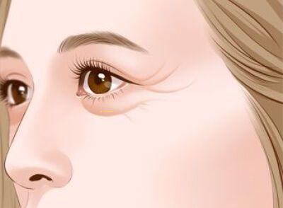 After chin augmentation