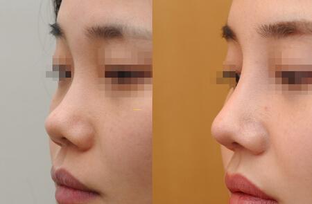 单纯硅胶假体隆鼻效果图片